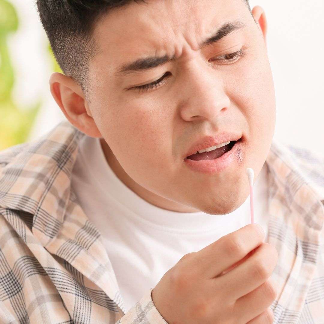 man putting ointment on cold sore