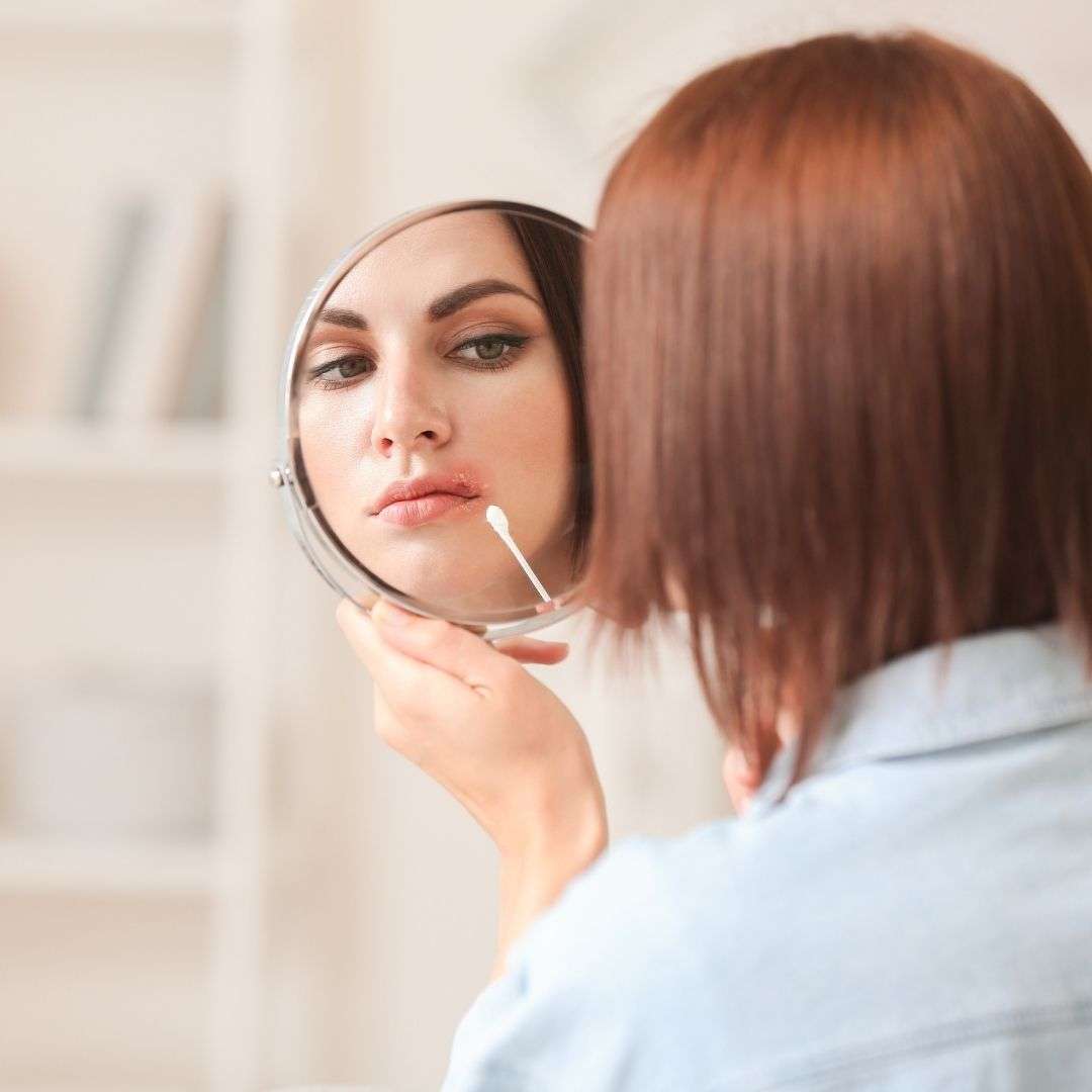 woman putting ointment on cold sore